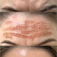 The Plasma Fibroblast Laser Pen